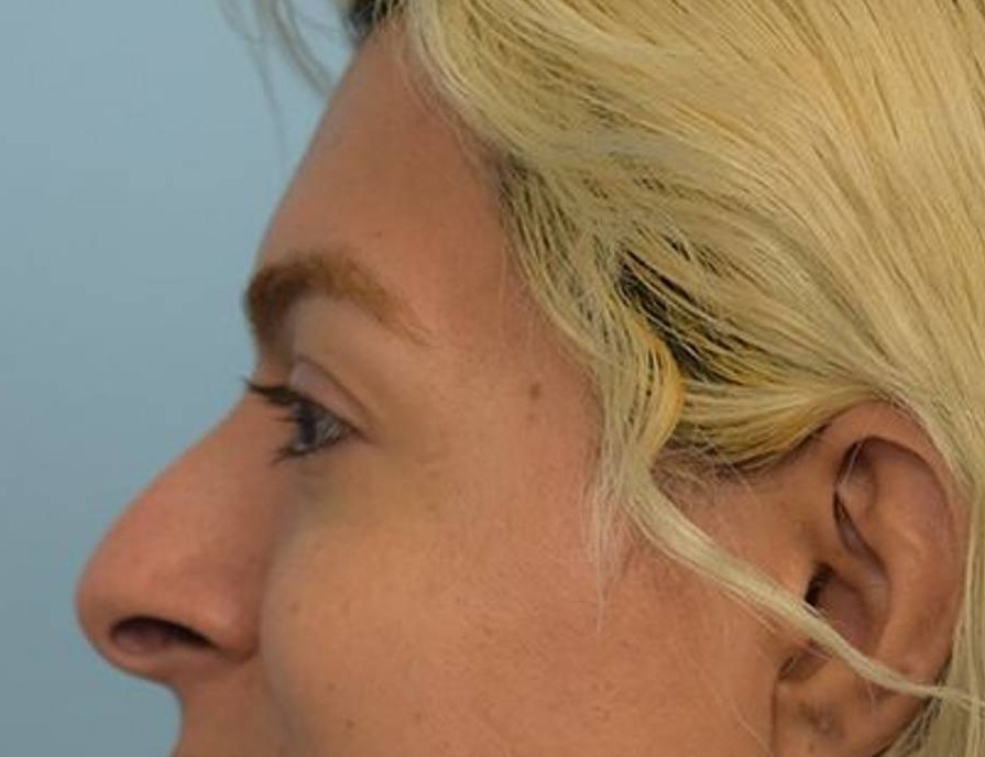 Rhinoplasty Before & After Image