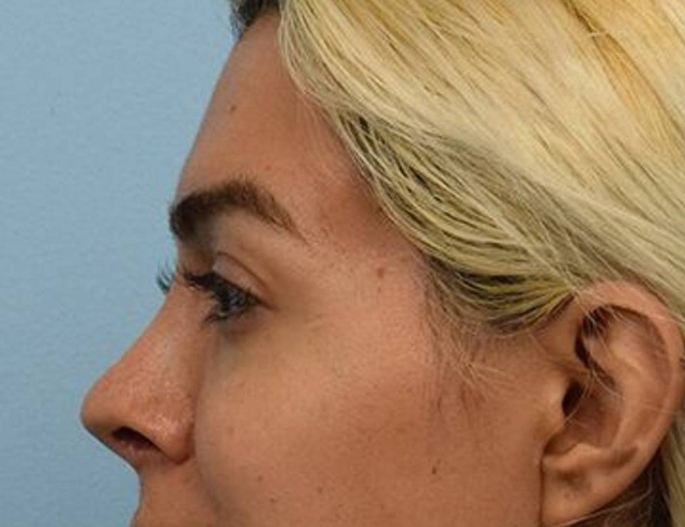 Rhinoplasty Before & After Image