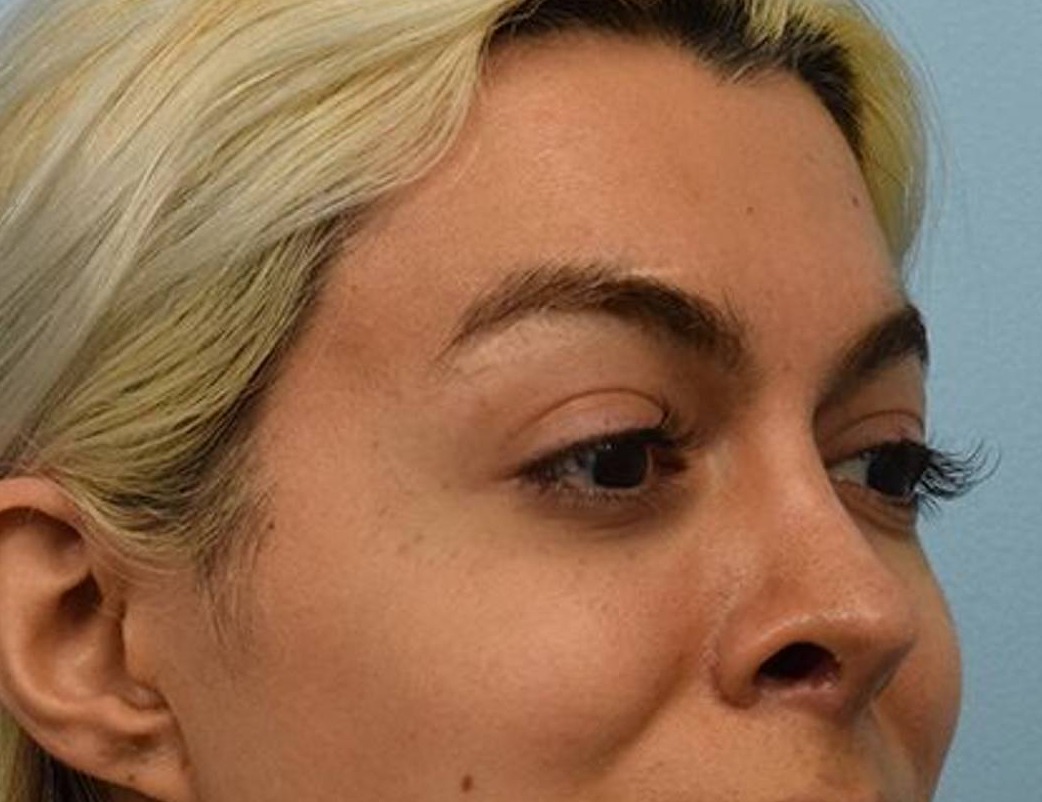 Rhinoplasty Before & After Image