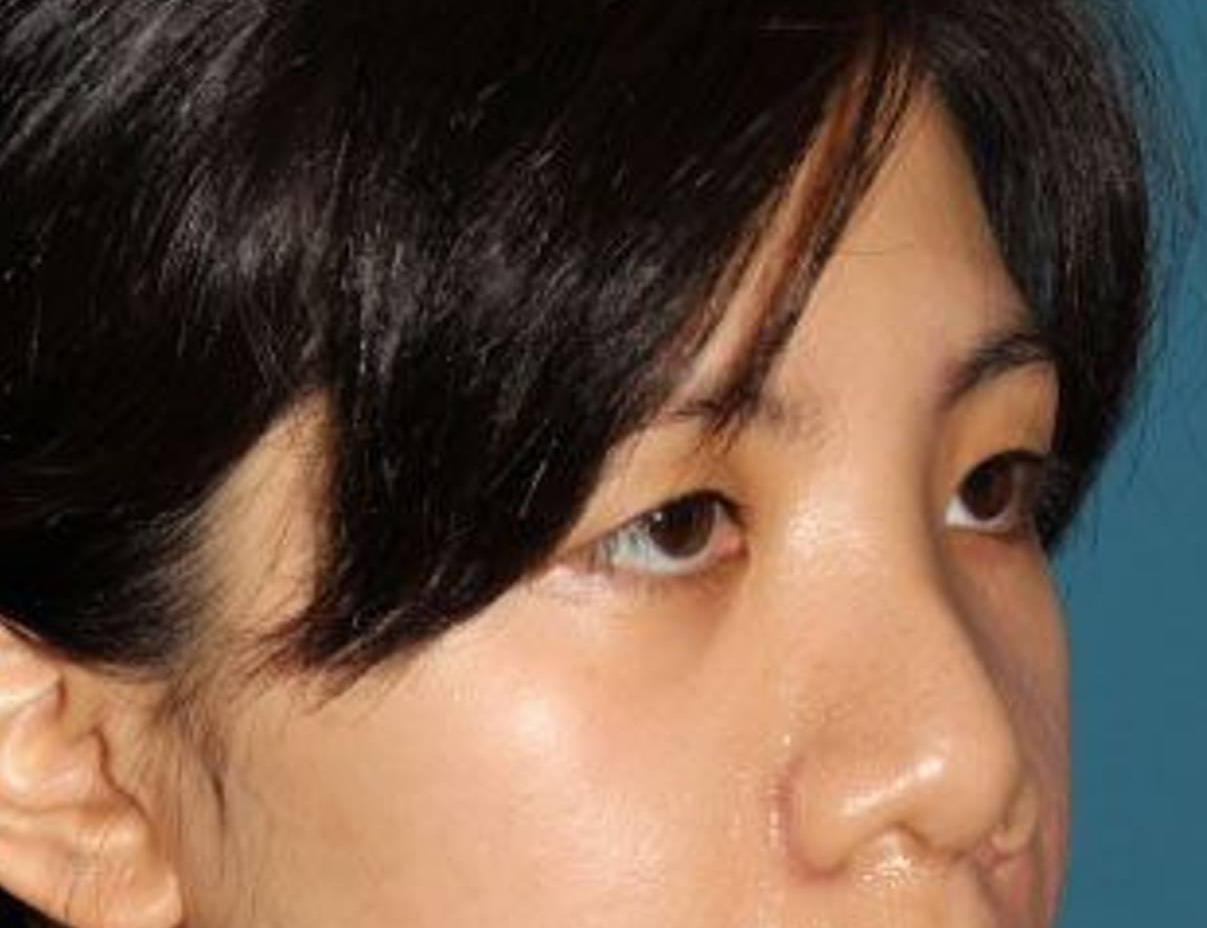 Rhinoplasty Before & After Image