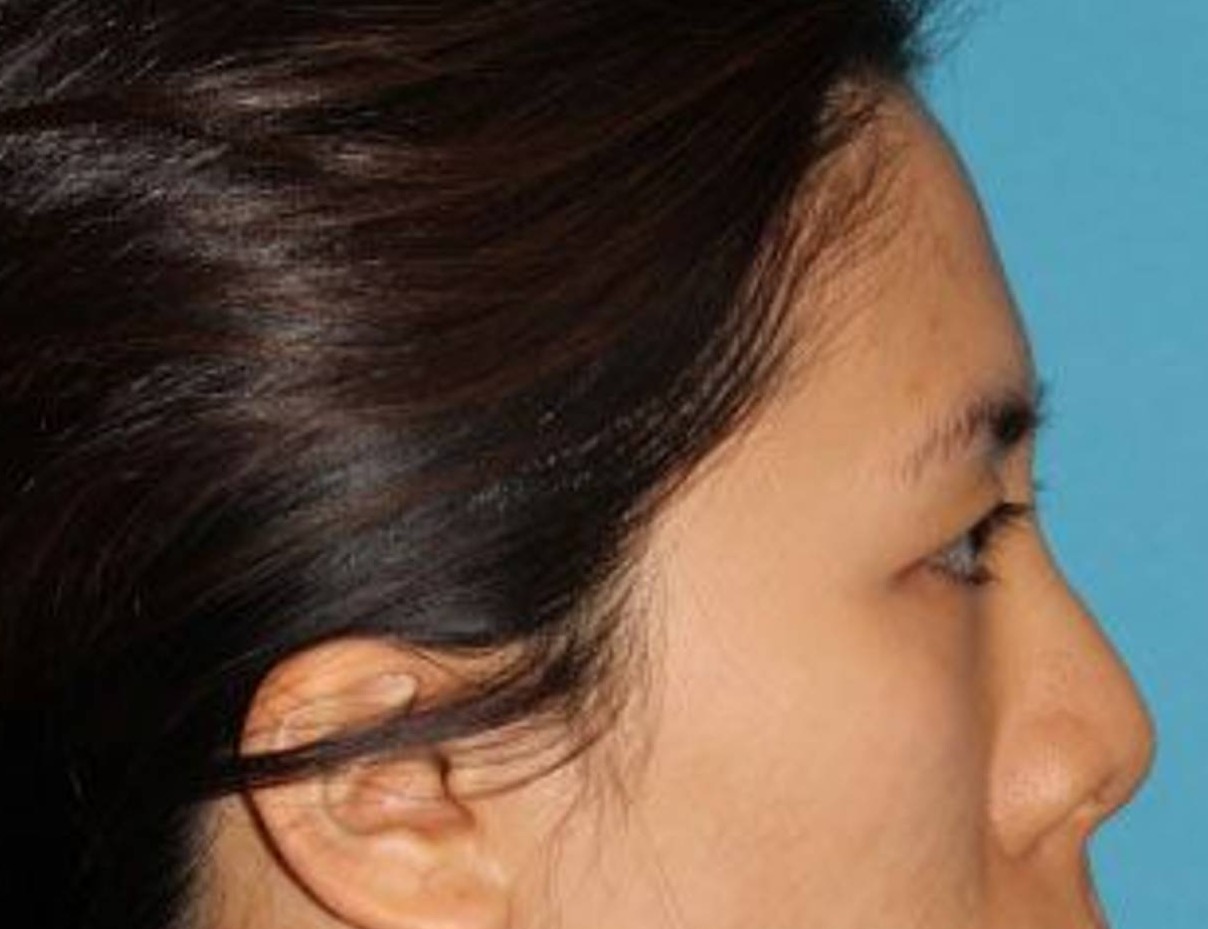 Rhinoplasty Before & After Image