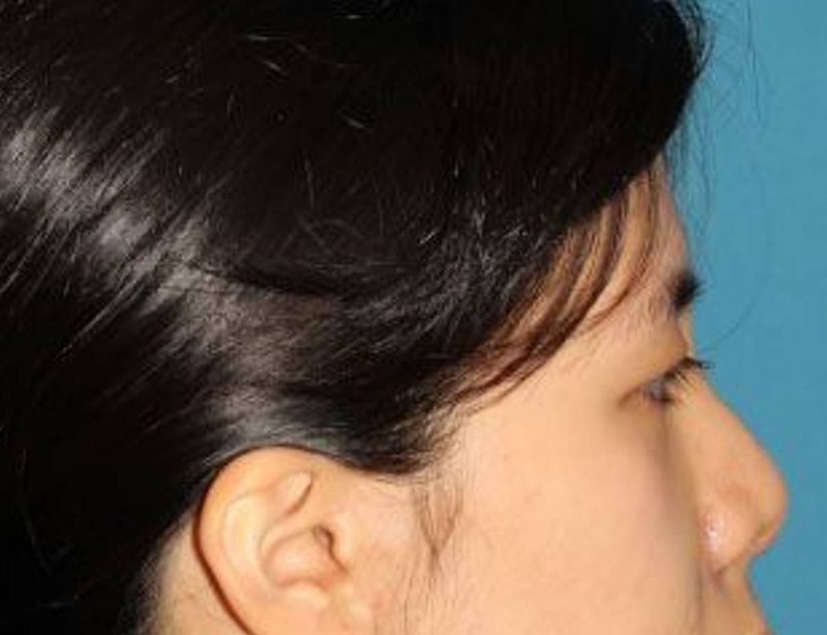 Rhinoplasty Before & After Image