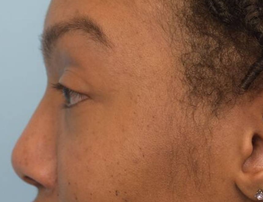 Rhinoplasty Before & After Image