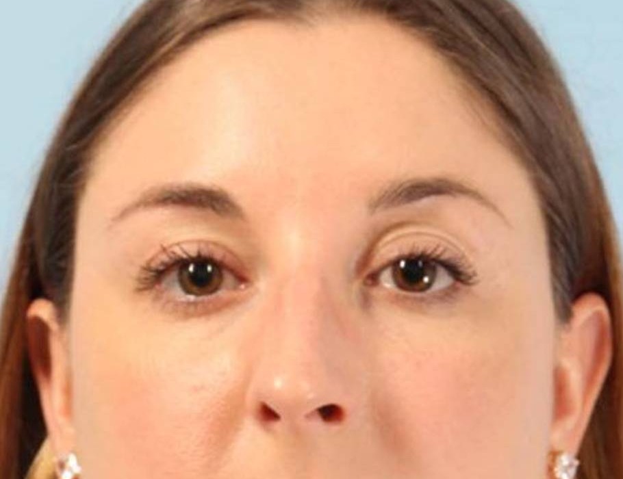 Rhinoplasty Before & After Image