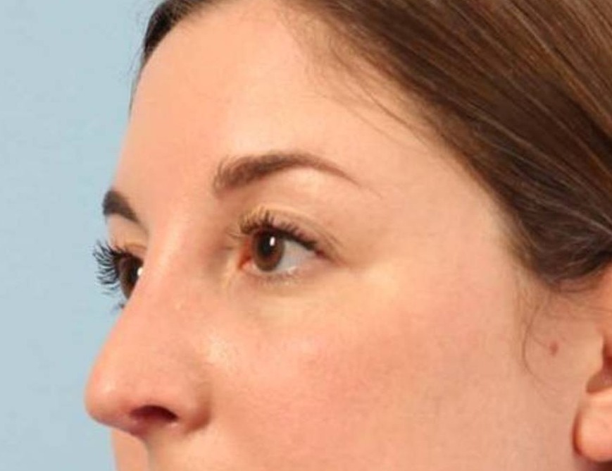 Rhinoplasty Before & After Image