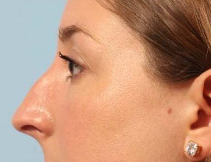 Rhinoplasty Before & After Image