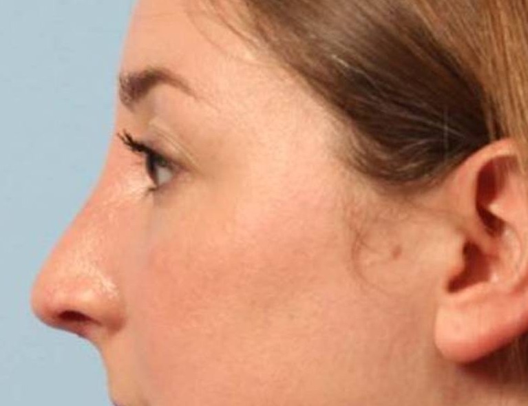 Rhinoplasty Before & After Image