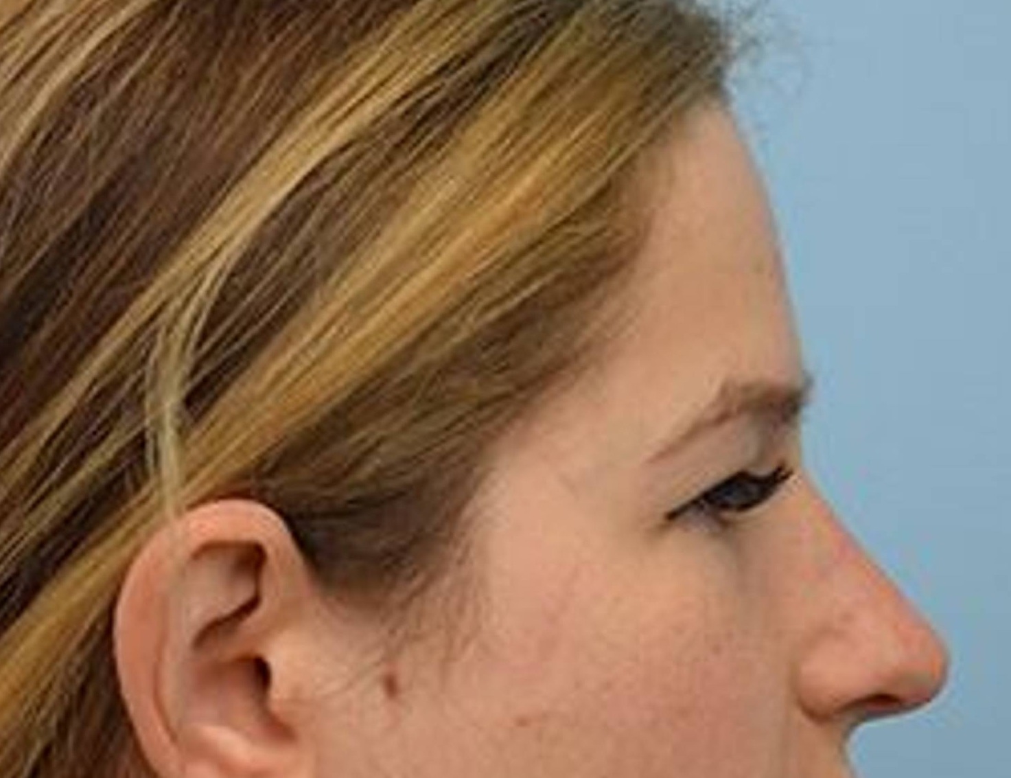 Rhinoplasty Before & After Image