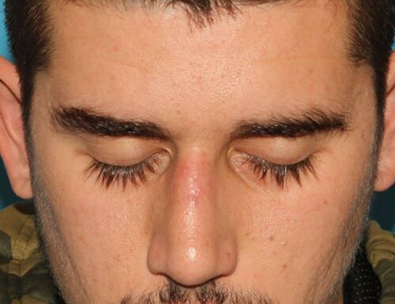 Rhinoplasty Before & After Image