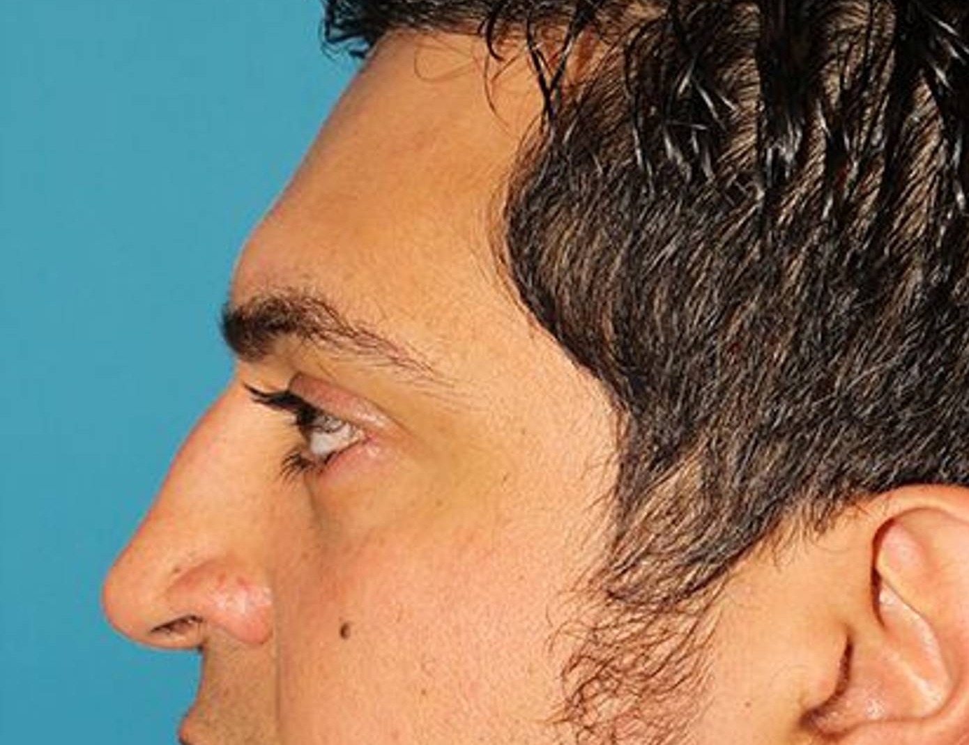 Rhinoplasty Before & After Image