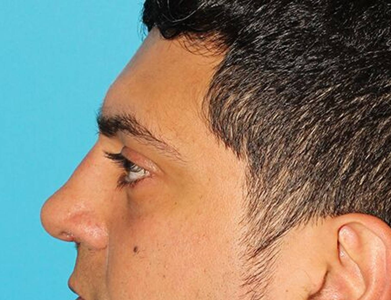 Rhinoplasty Before & After Image