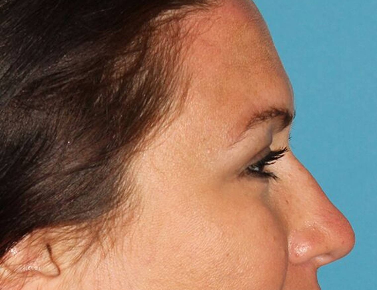 Rhinoplasty Before & After Image