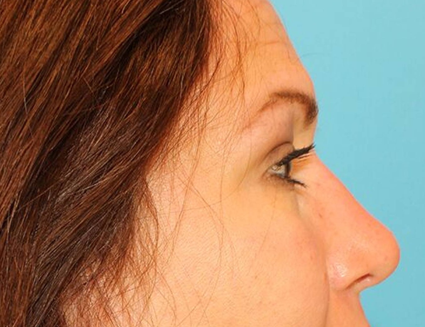 Rhinoplasty Before & After Image