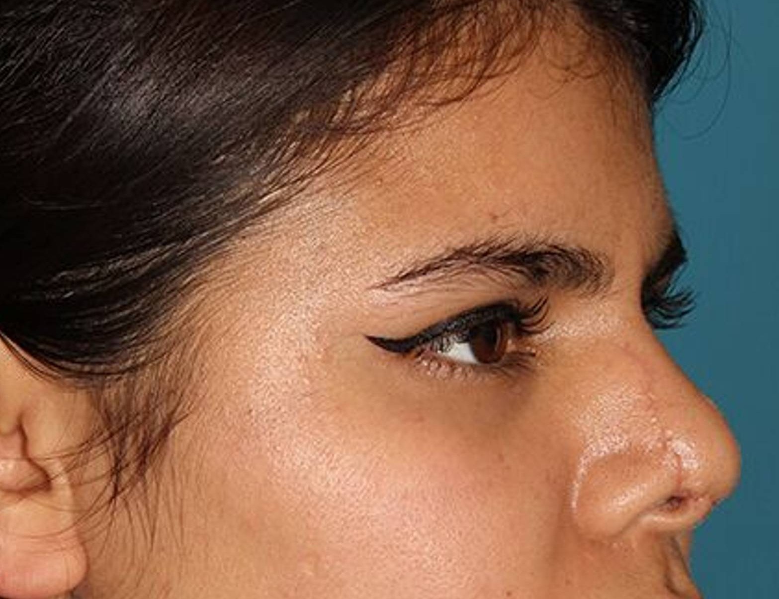 Rhinoplasty Before & After Image