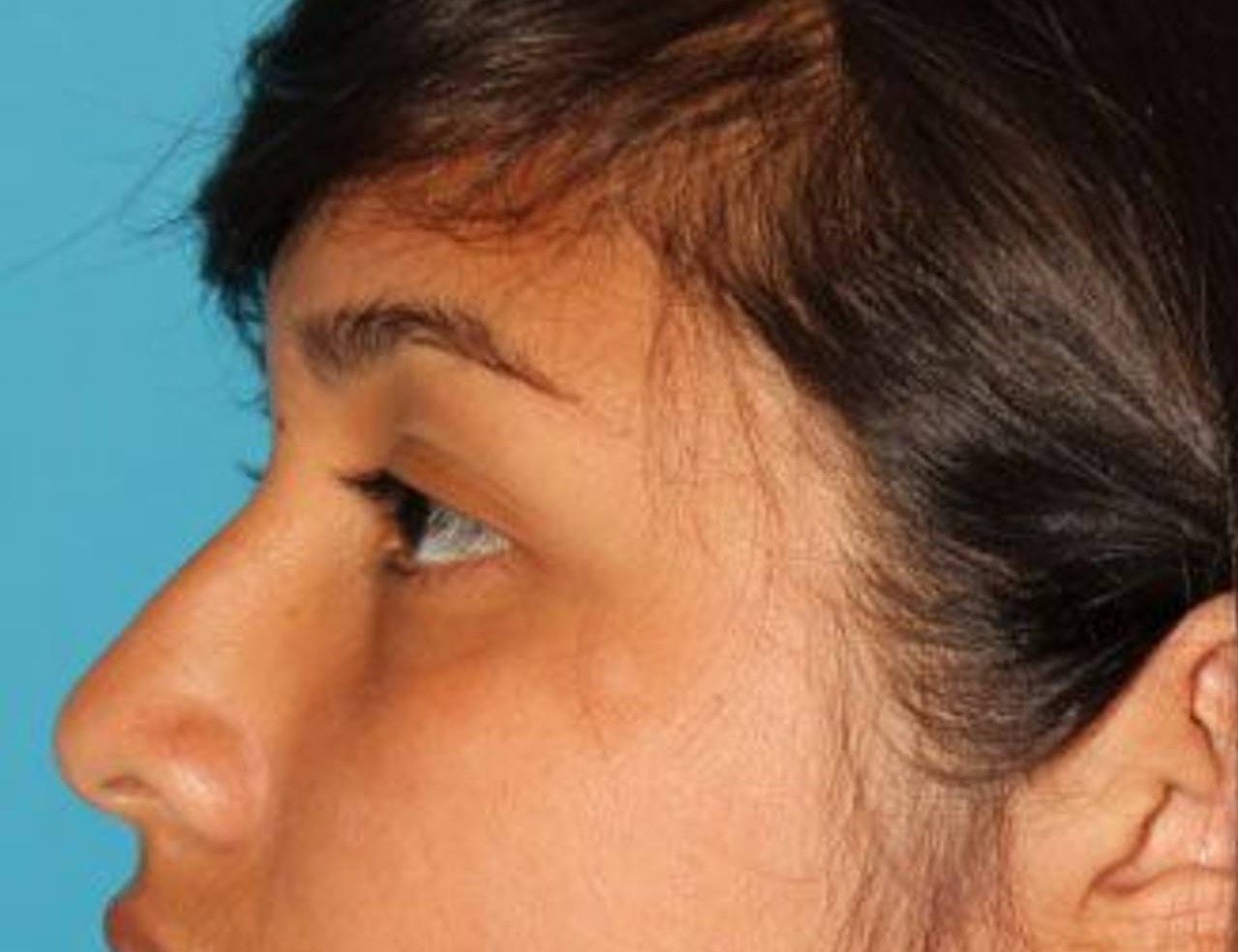 Rhinoplasty Before & After Image