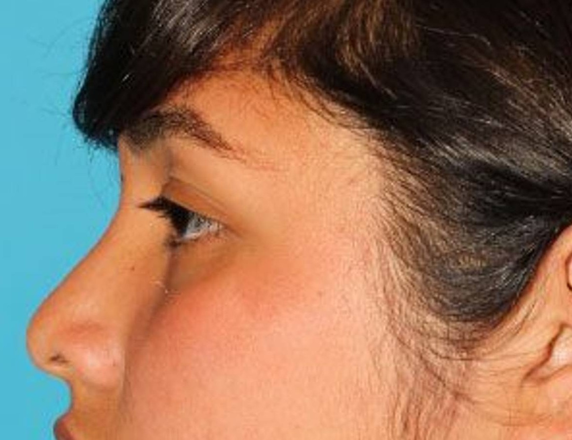 Rhinoplasty Before & After Image