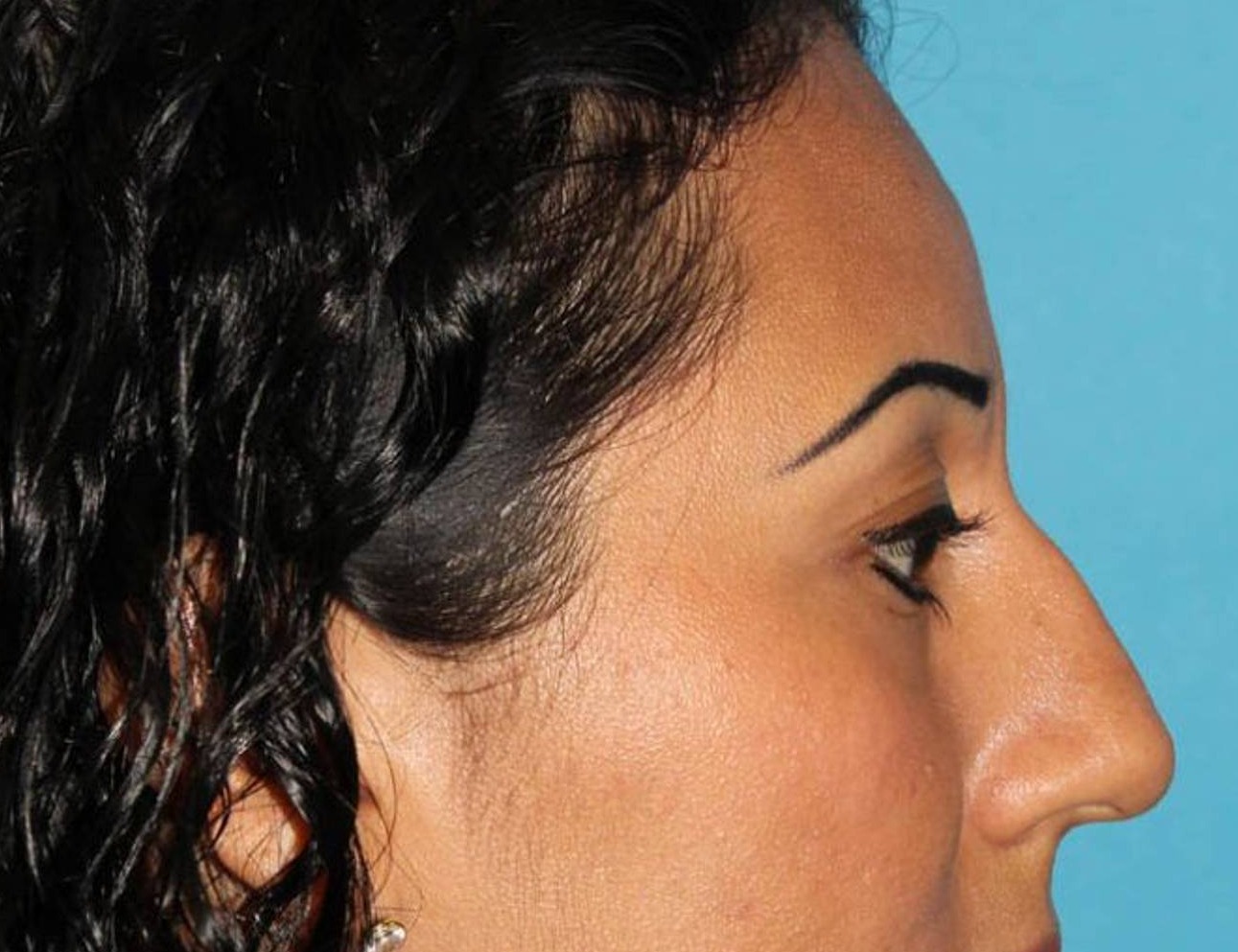 Rhinoplasty Before & After Image