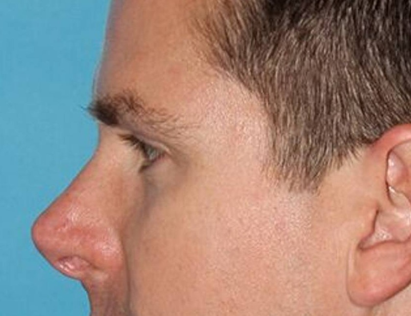 Rhinoplasty Before & After Image