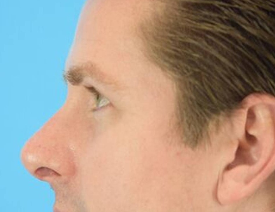 Rhinoplasty Before & After Image