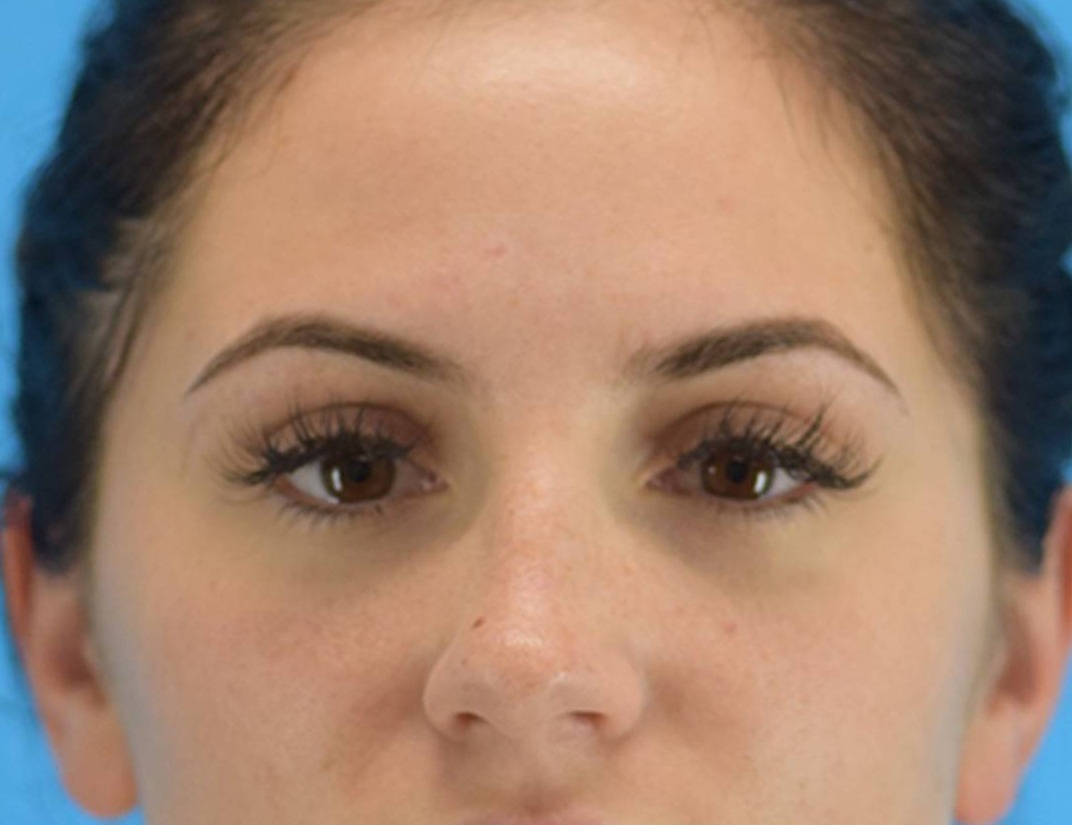 Rhinoplasty Before & After Image