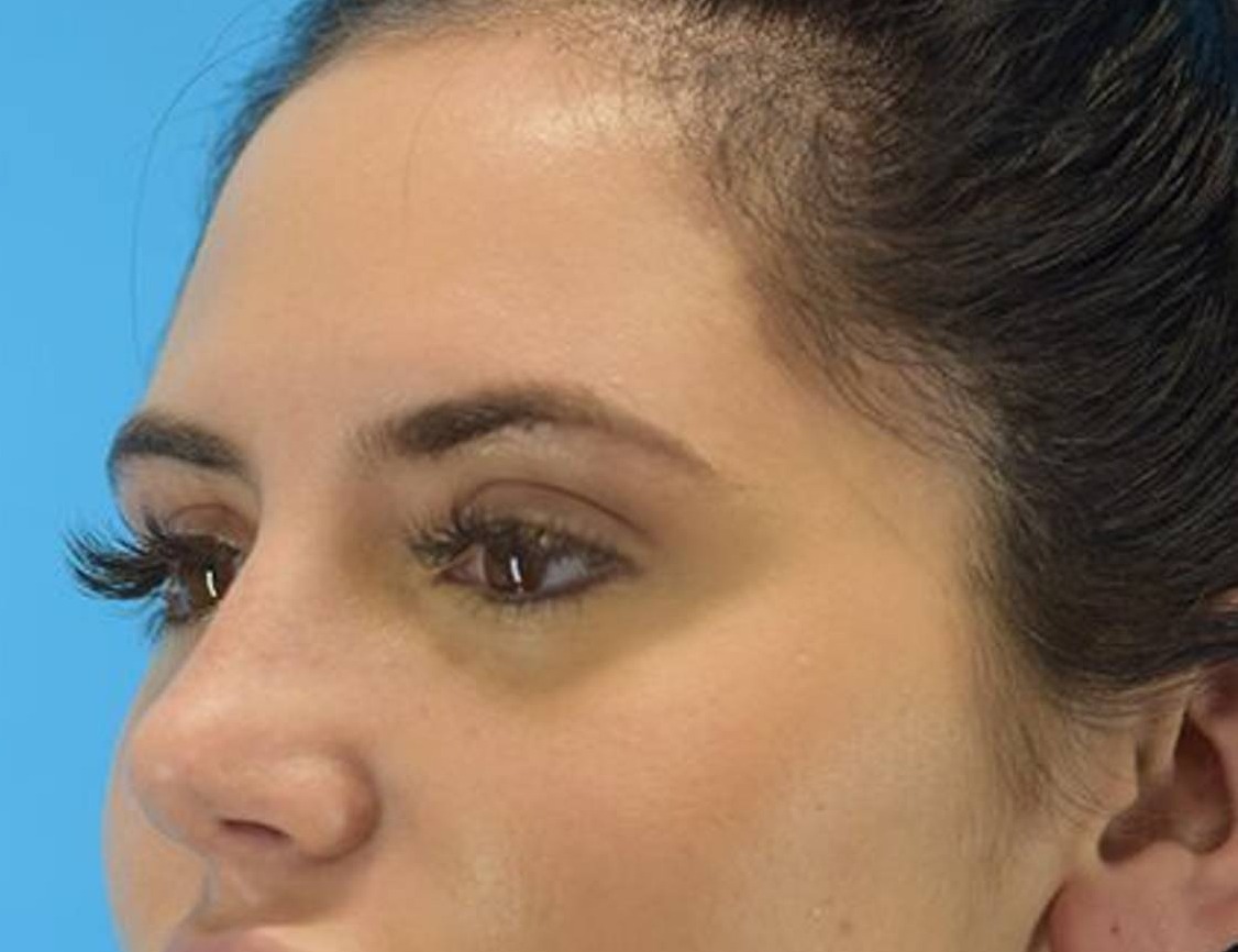 Rhinoplasty Before & After Image