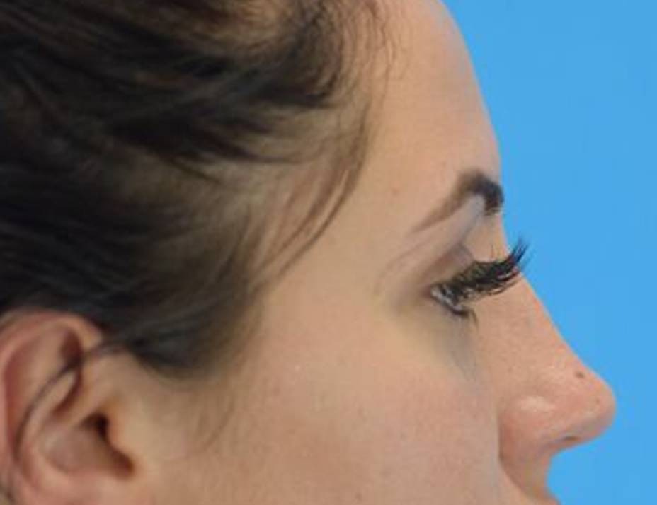 Rhinoplasty Before & After Image