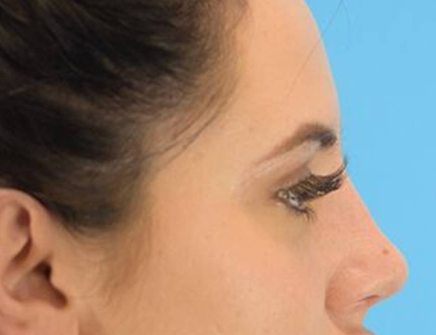 Rhinoplasty Before & After Image