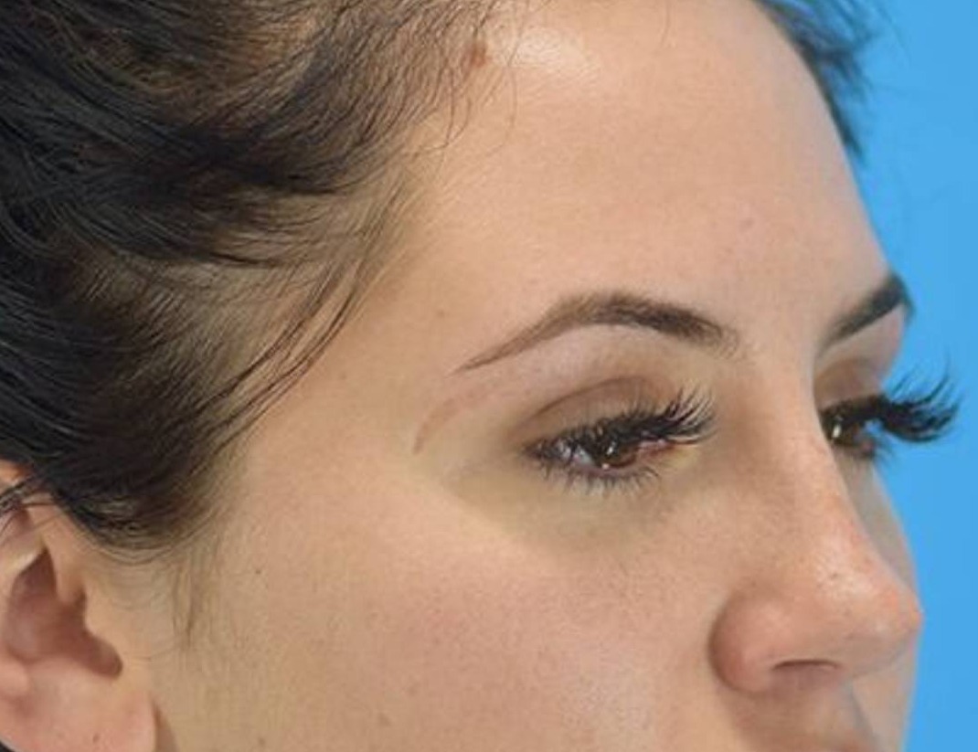 Rhinoplasty Before & After Image