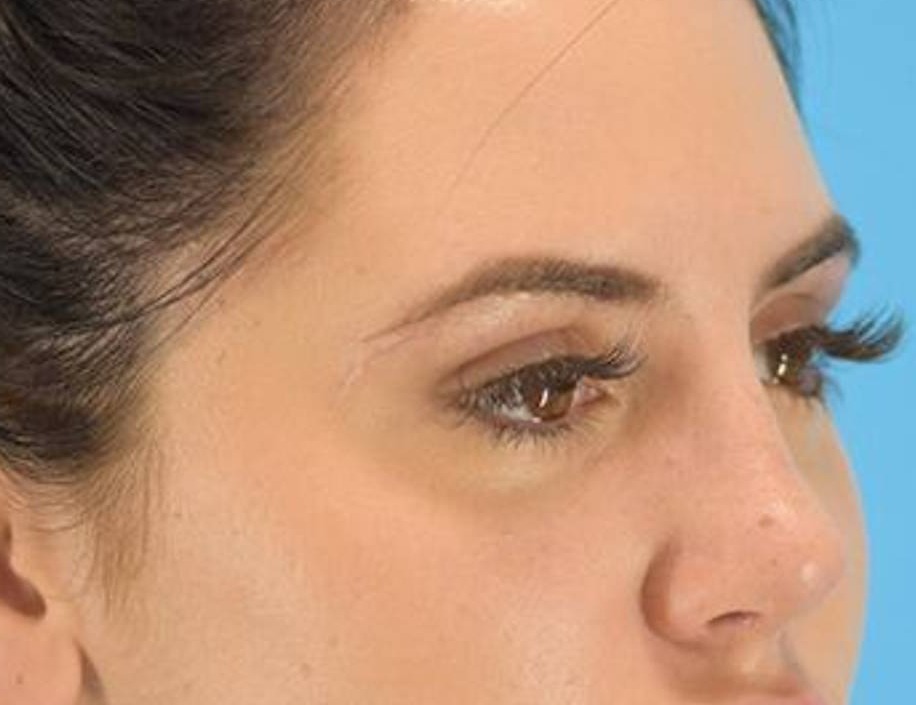 Rhinoplasty Before & After Image