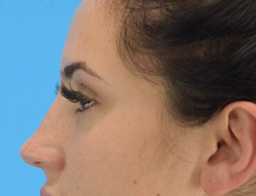 Rhinoplasty Before & After Image