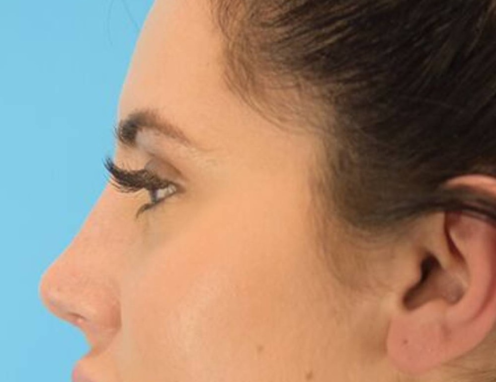 Rhinoplasty Before & After Image