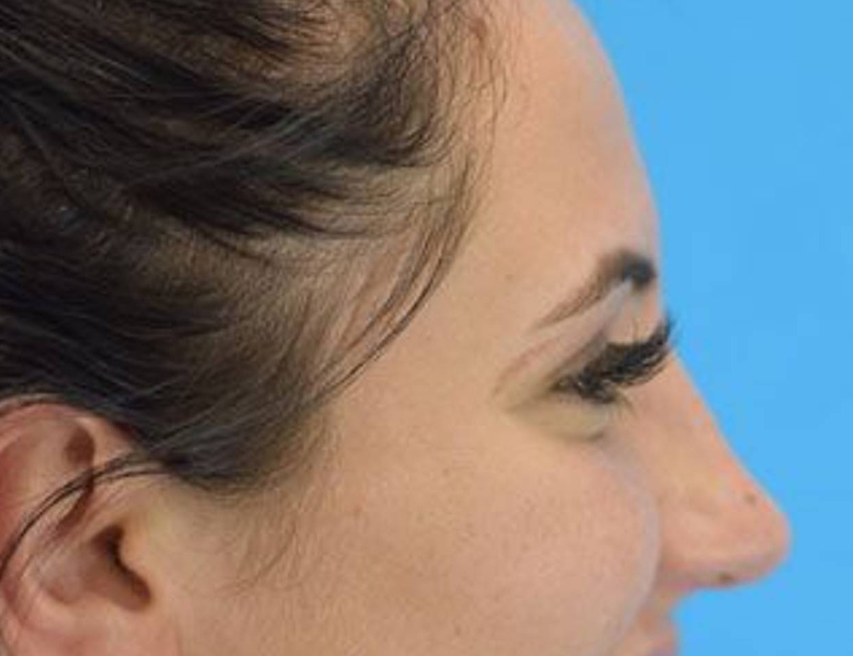 Rhinoplasty Before & After Image