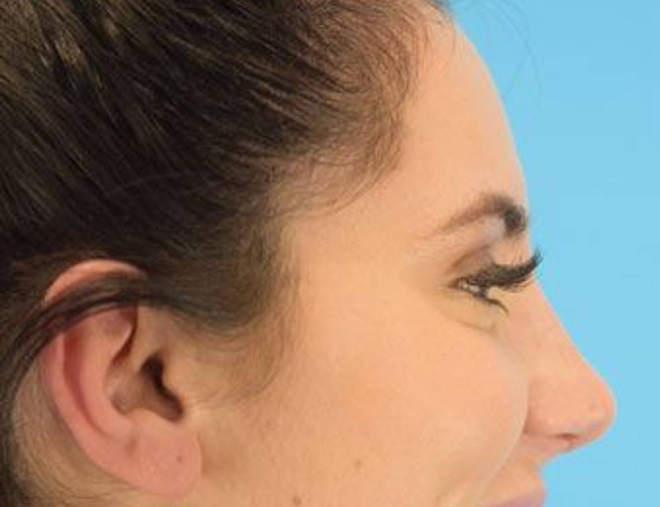 Rhinoplasty Before & After Image