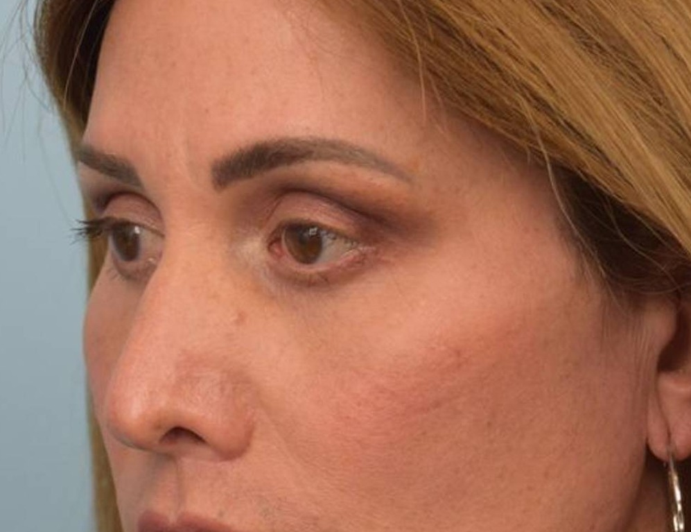 Rhinoplasty Before & After Image