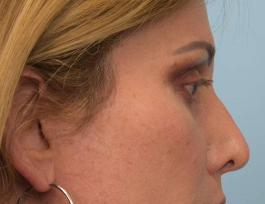 Rhinoplasty Before & After Image