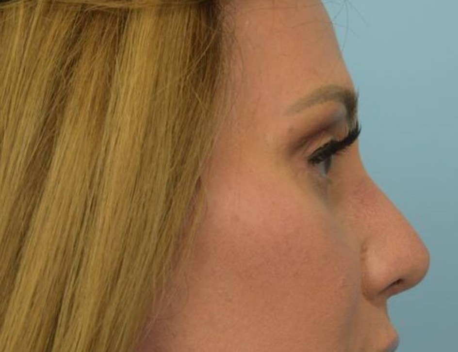 Rhinoplasty Before & After Image