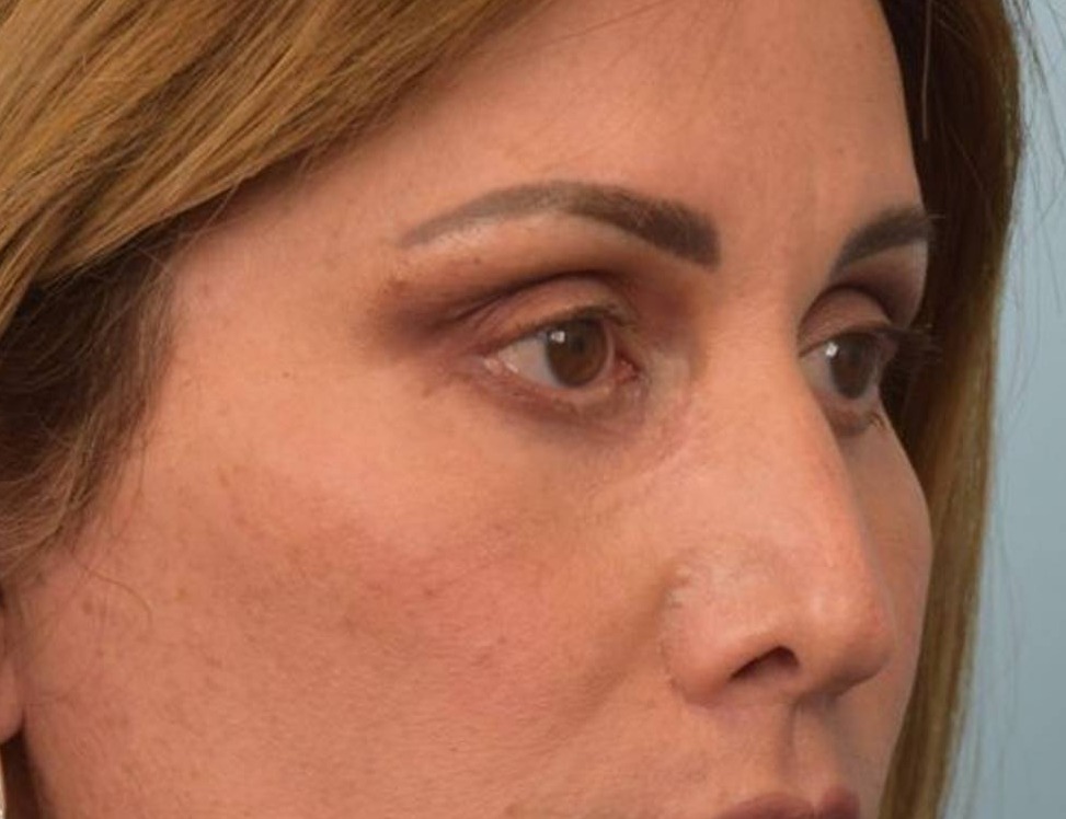 Rhinoplasty Before & After Image