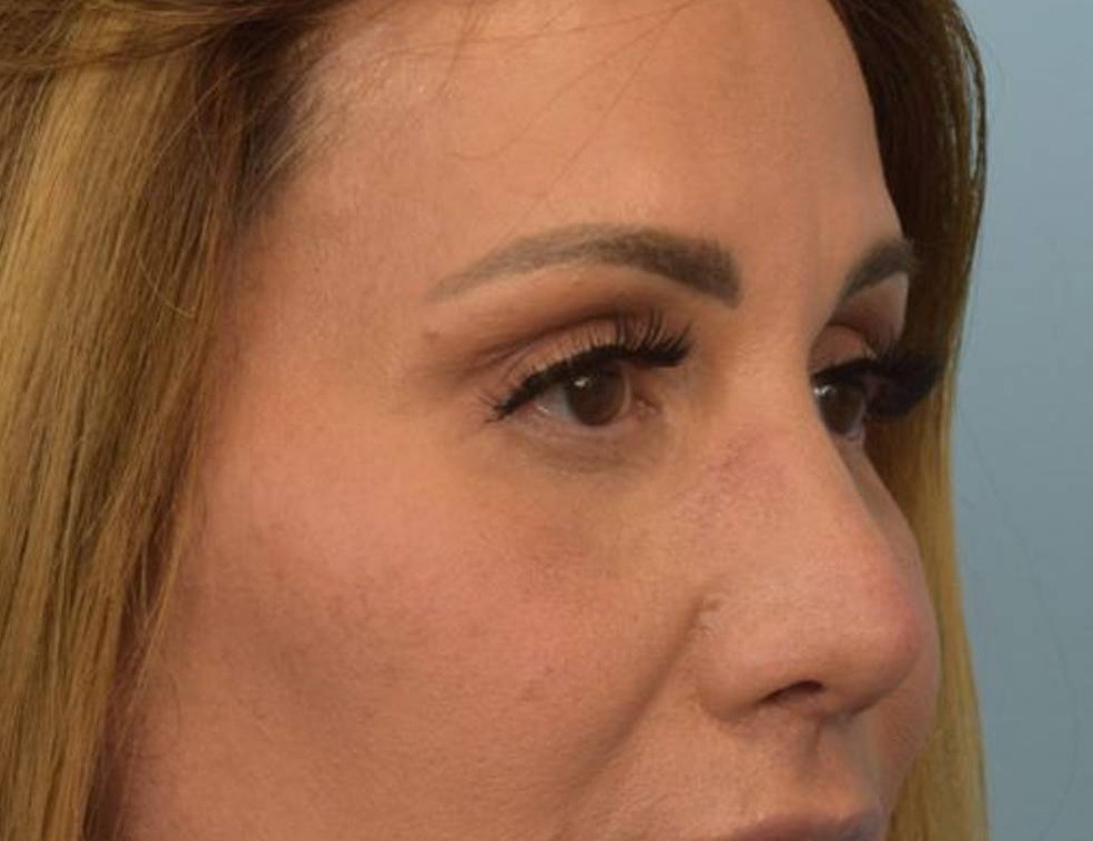 Rhinoplasty Before & After Image