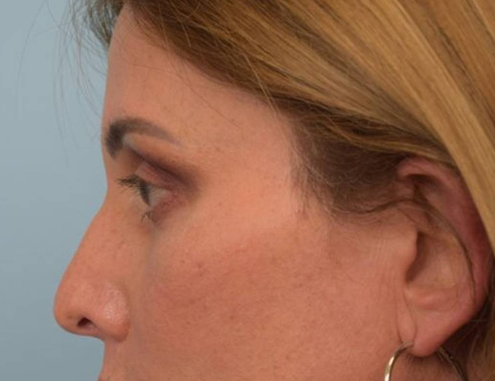 Rhinoplasty Before & After Image