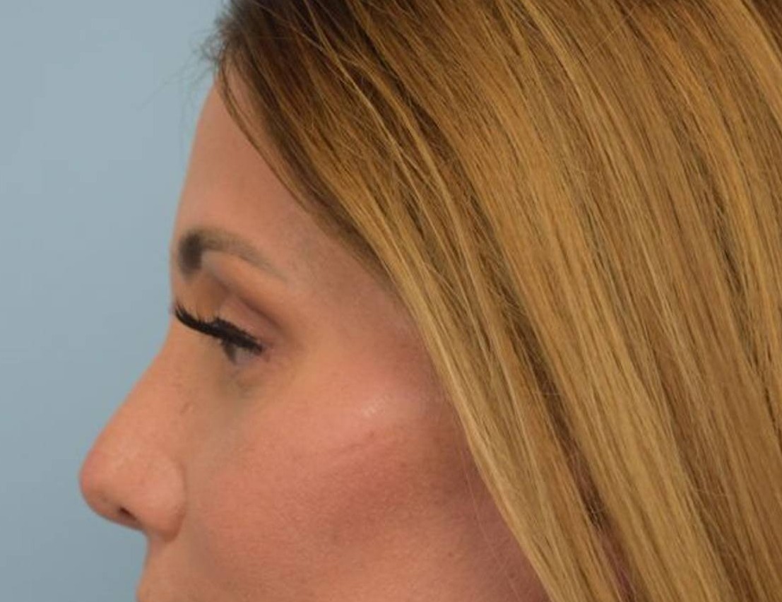 Rhinoplasty Before & After Image