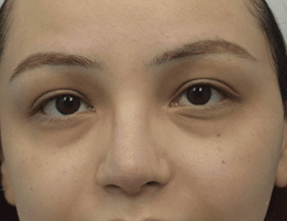 Rhinoplasty Before & After Image