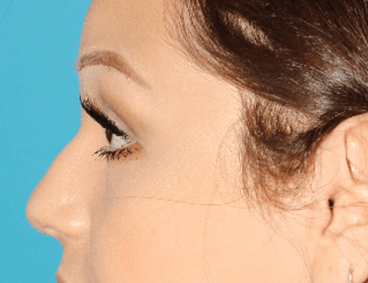 Rhinoplasty Before & After Image