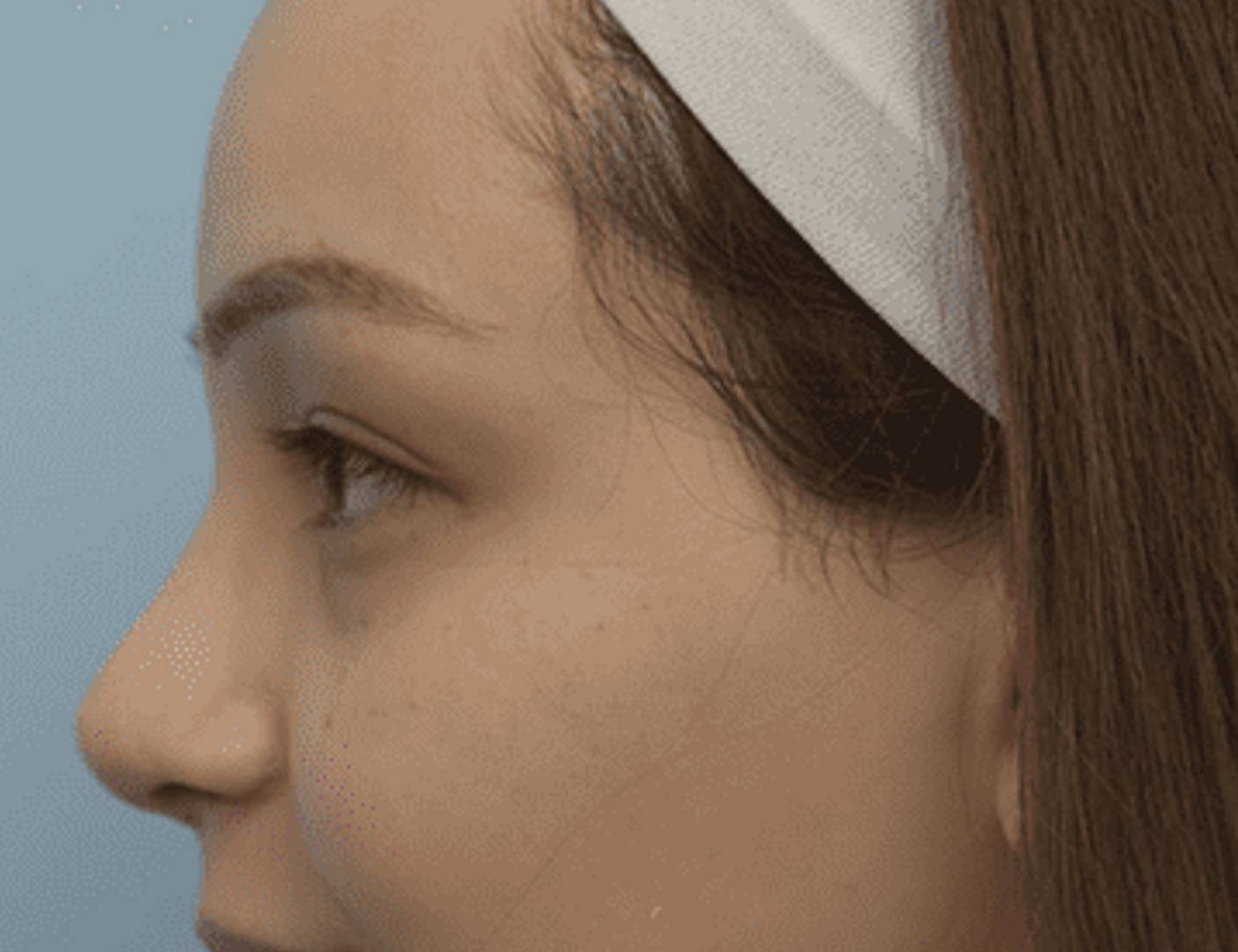 Rhinoplasty Before & After Image