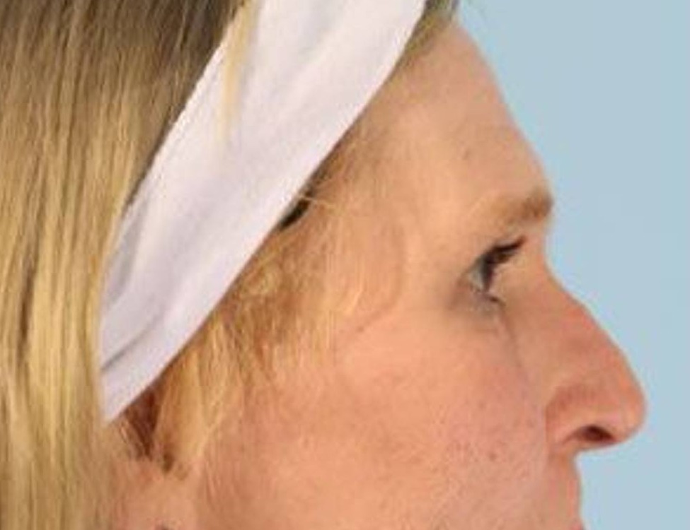 Rhinoplasty Before & After Image