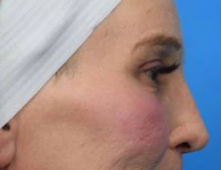 Rhinoplasty Before & After Image