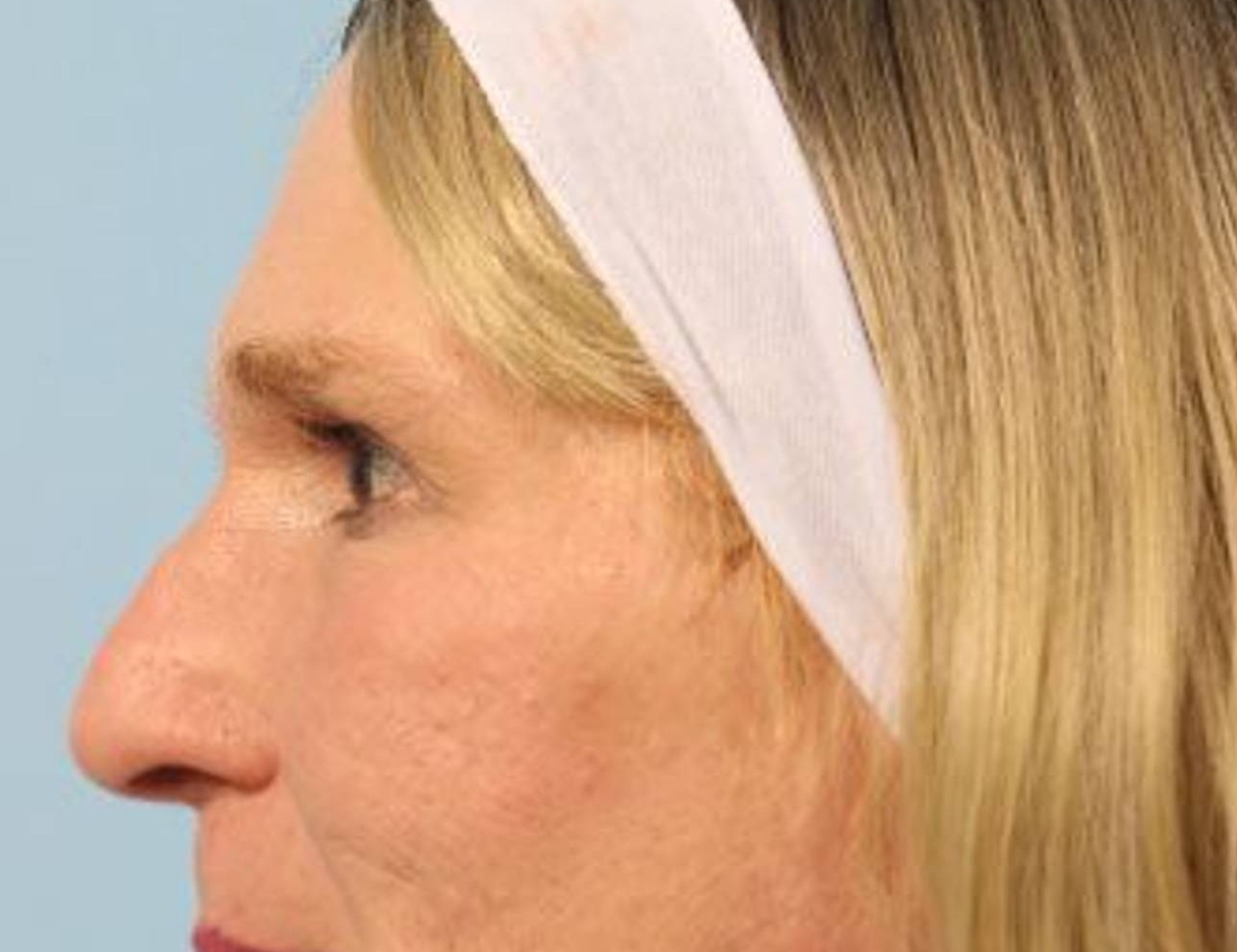 Rhinoplasty Before & After Image