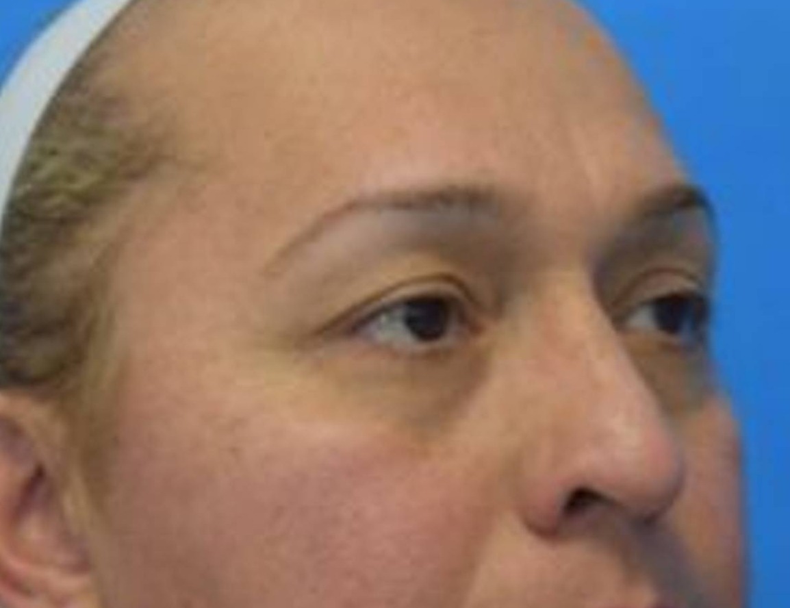 Rhinoplasty Before & After Image