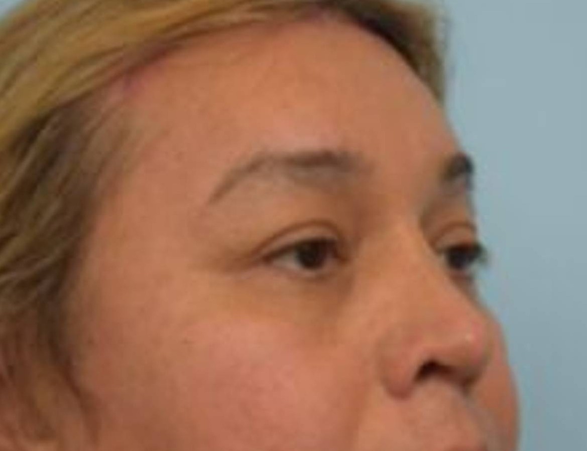 Rhinoplasty Before & After Image