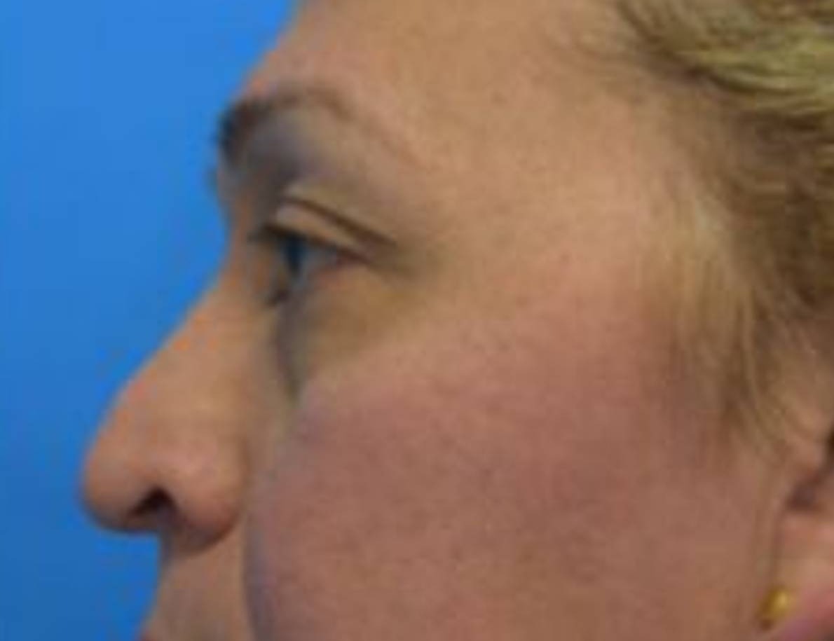 Rhinoplasty Before & After Image