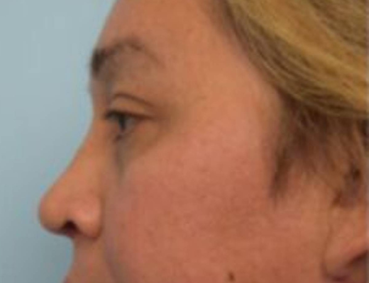 Rhinoplasty Before & After Image